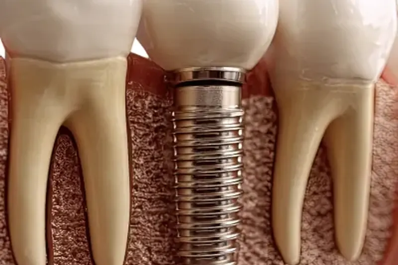 Implante Dentario em Taguatinga - Clínica OdontoLinea